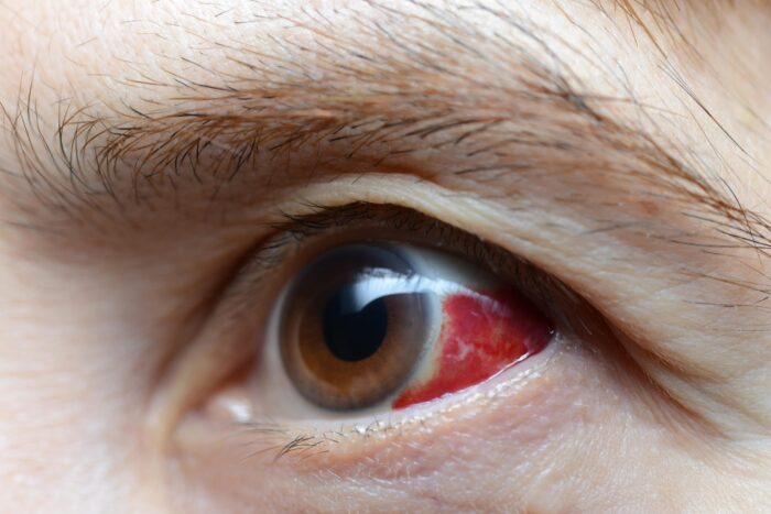 Trauma ocular: o que é e quais os cuidados para a reabilitação da visão